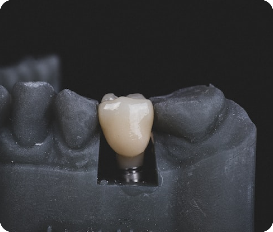 Имплантация зубов